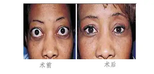 高度近视的前房较深,瞳孔较大,眼球因前后轴长而显得稍有突出.