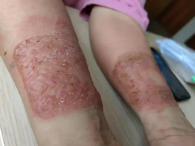 红肿瘙痒 密集水疱,过敏了!-朱敏刚主任医师-爱问医生