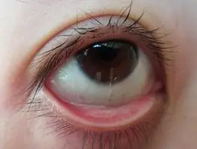 特别眼部的卫生,眼睛是很脆弱的,很容易感染各种眼疾,比如结膜炎,接