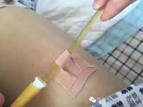 云南省肿瘤医院管道护理专科小组管道固定方式二