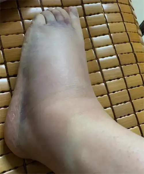 挤地铁造成左脚脚踝扭伤,塞来昔布胶囊等药物促恢复_寻医问药频道