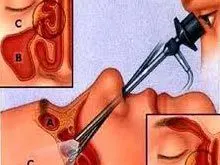 鼻黏膜肿胀多见于鼻炎,鼻炎的表现多种多样.