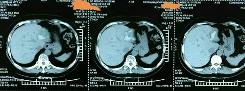 术前ct提示:左肝肝内胆管结石.