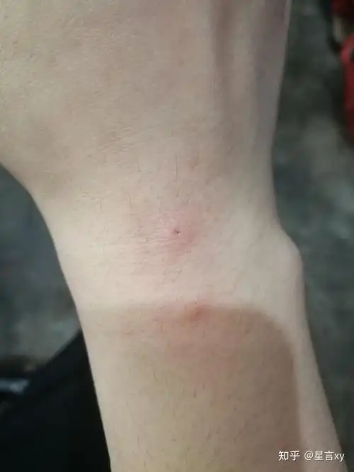 被猫咬伤出血了心里很慌