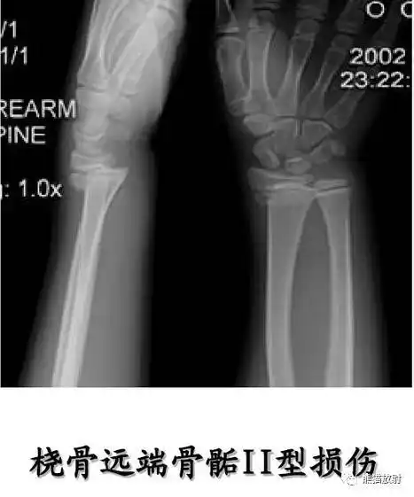 骨骺骨折 physeal fractures