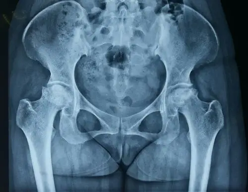 双侧股骨头坏死(双侧人工髋关节置换术) - 好大夫在线