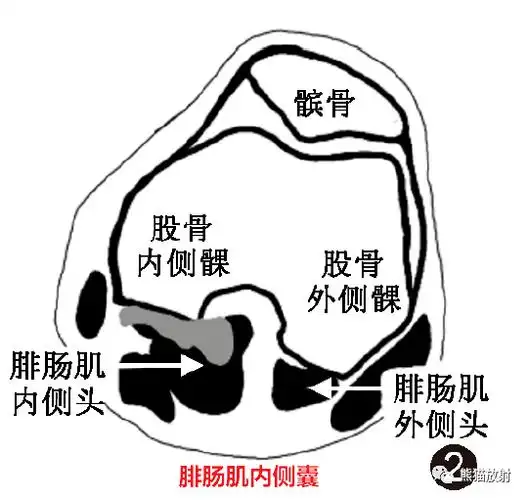 超赞膝关节滑囊分组示意图