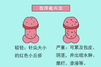 龟头发炎图片