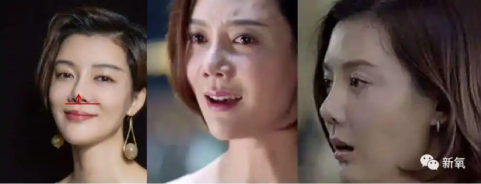 才不到两年,娜扎的鼻子怎么就歪掉了?连鼻孔都一高一低