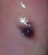 口腔壁上长了两个血泡,我用针挑破了一个,还剩下一个挑不破,这到底是