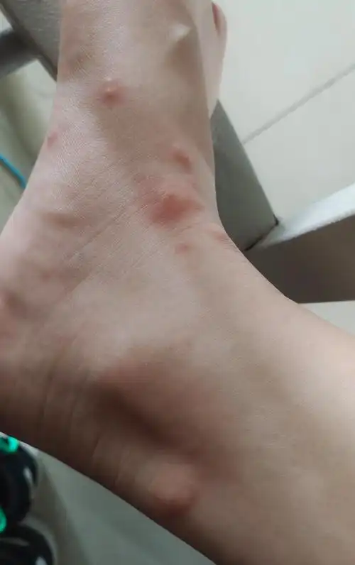 被蚂蚁咬之后用药什么更有效呢? - 知乎