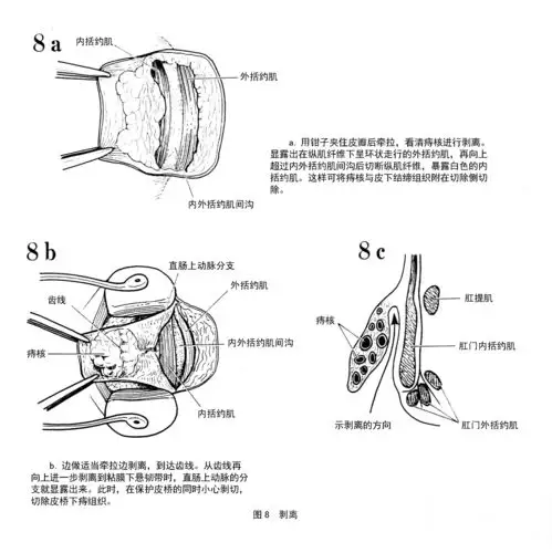 痔的基本术式--外剥内扎术图解