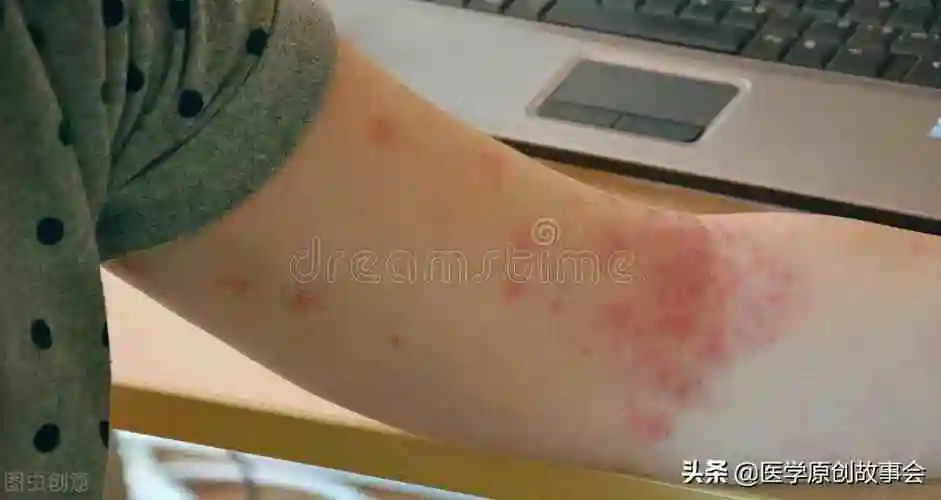 艾滋病有哪些症状图片艾滋病人外貌特征图片