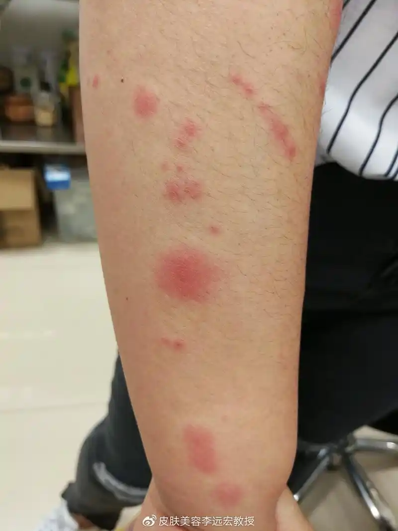 由于蚊虫叮咬引起的丘疹性荨麻疹67吃药过敏引起的荨麻疹型药疹荨