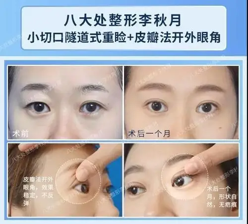 开外眼角为什么会回缩?