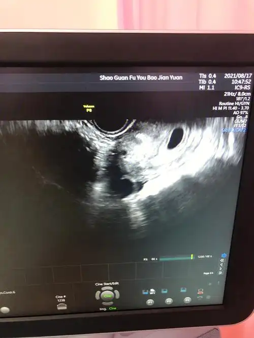 移植3天冻胚胎2枚,看到一枚孕囊,圈起来是右边,不知道是宫外孕还是