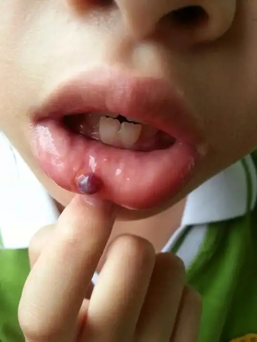 她嘴里长了个这个疙瘩请问是怎么回事?