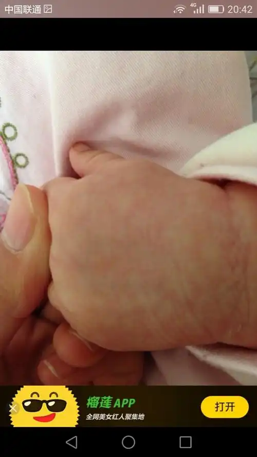 3个月的宝宝皮肤有花斑,是怎么回事?