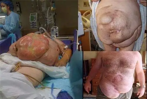 日喀则疝专家_日喀则治疗疝哪个专家好_日喀则治疗疝最