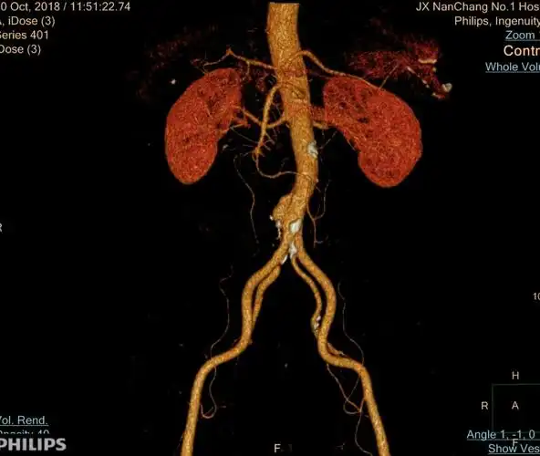 图1-术前ct评估,肾下腹主动脉瘤,右髂内开口狭窄,左髂内动脉开口距离