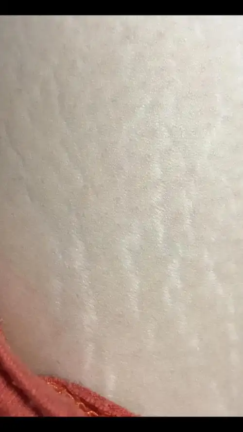 当初怀孕胖太快了,大腿上的妊娠纹