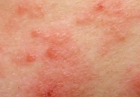 湿毒图片 (18)_有来医生