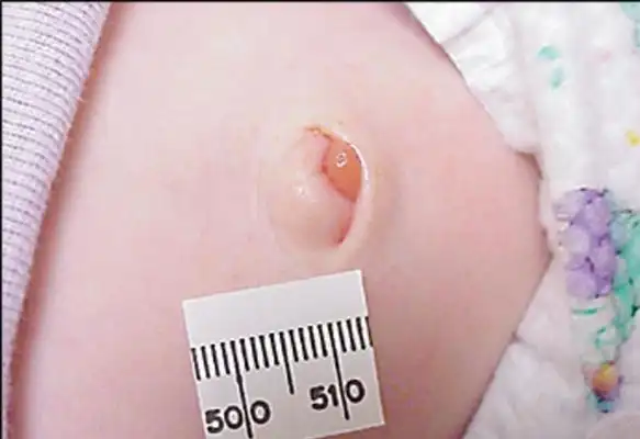 婴儿肚脐突出图片43