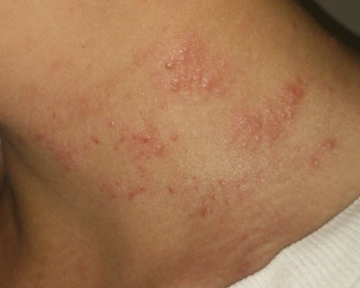 医生,脖子上长的是什么,很痒