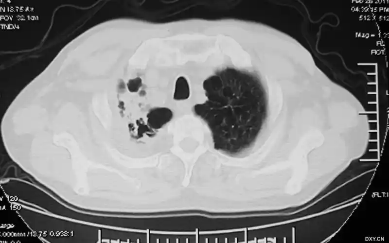 有慢性支气管炎十余年,肺气肿9年.增加了新图像资料,以作对比.