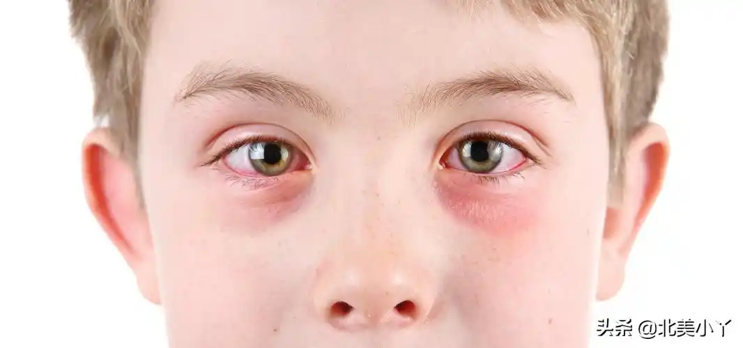 小丫说医 | 出现眼睛红肿,有眼屎未必是上火了,要警惕3种结膜炎