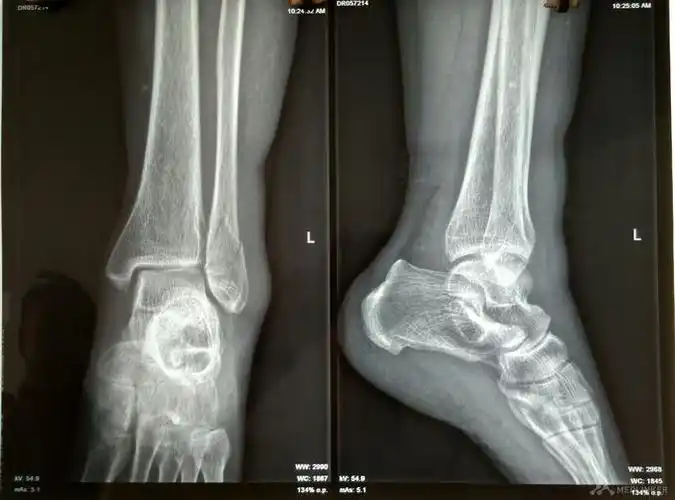 左踝关节骨折脱位