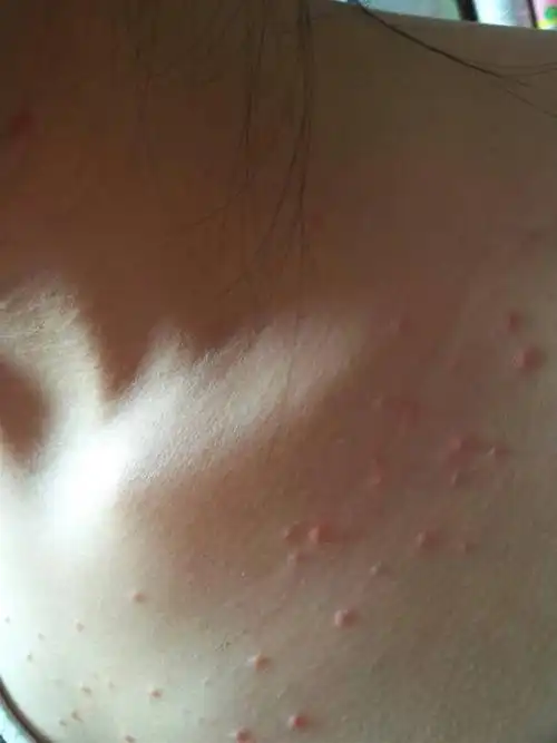 问:突然胸前起小红疙瘩,不痒不疼,起了好几天啦,不是浑身过敏,只在