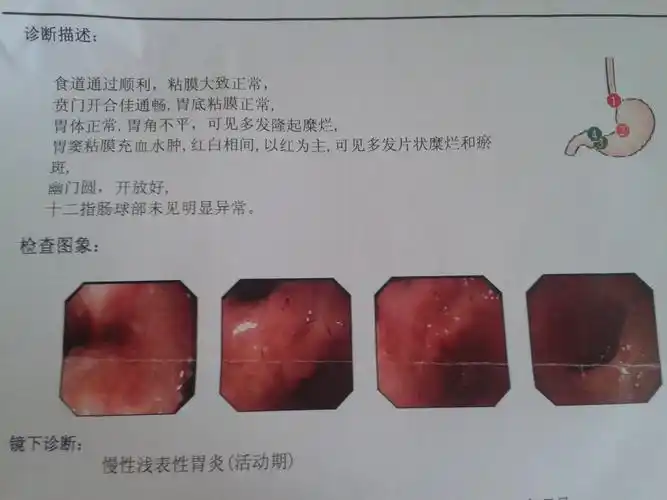 我曾为它感到无助,忧愁---慢性胃炎治疗经验分享