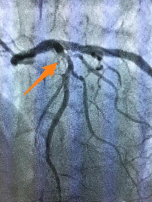 术前:前降支近段弥漫性狭窄最重约90%