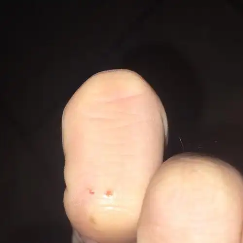 被我家养的小泰迪咬了