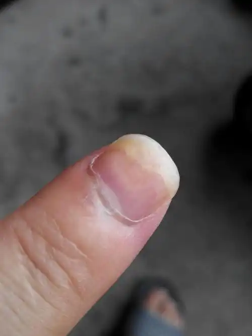 指甲内空怎么办从怀孕一段时间后就出现这种情况现在宝宝都六个月了