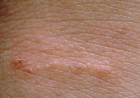 人的疥螨是什么症状?_治疗_消毒_疥虫