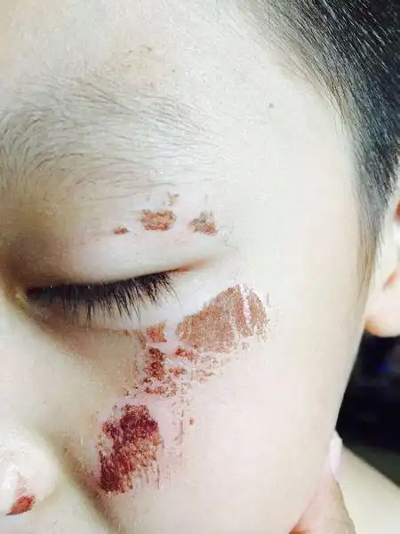 孩子摔跤,脸蹭地了,只是擦伤,会留疤吗?有什么注意事项吗?