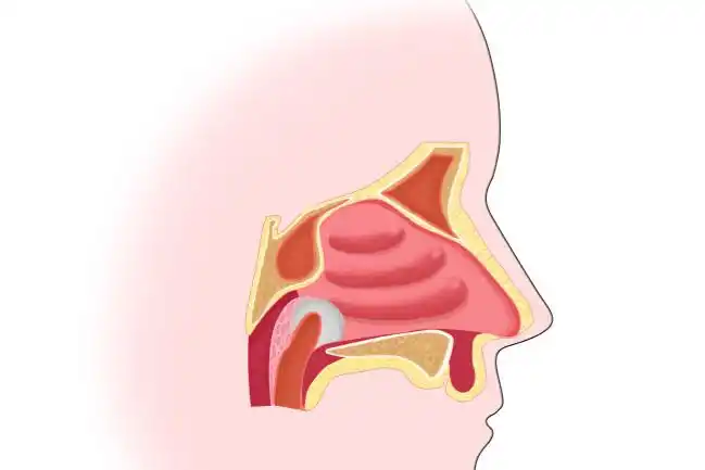 女孩频繁挖鼻孔,颅内感染险丧命_花花_鼻腔_海绵