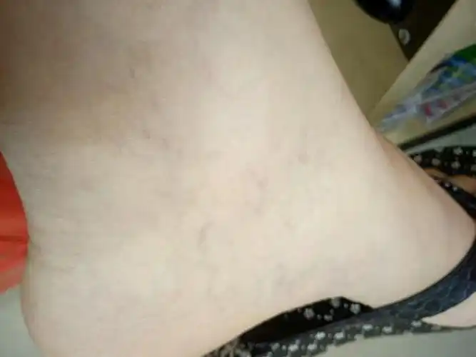 脚这里很多紫色血管丝怎么回事?