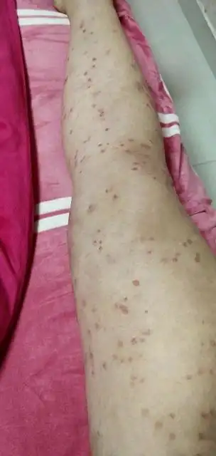 寻常型银屑病早期图片