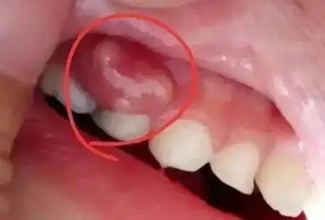 为什么牙龈总是长脓包