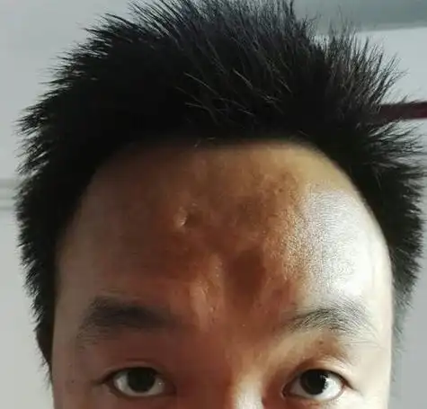 (图片来源网络,侵删)额头凹陷坑怎么办为什么额头会凸出来额头骨头