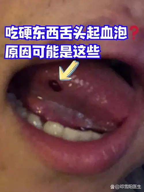 吃硬东西舌头起血泡原因可能是这些 进食坚果,啃咬排骨时,舌头突然