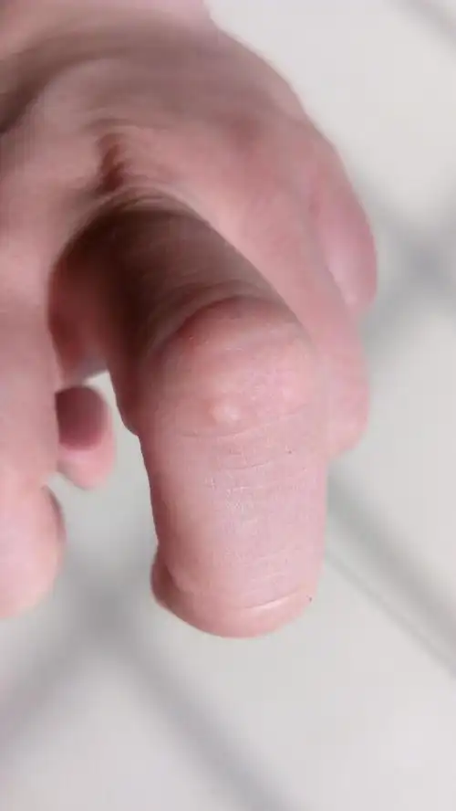 病例讨论扁平疣手指关节