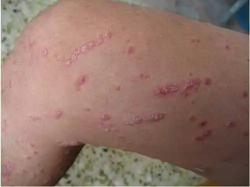 上面的内容排名最好的牛皮癣医院医生就