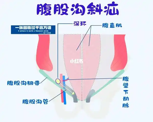 直疝  #斜疝  #医学插图  #每日一图  #护士懂护士  #腹股沟疝气