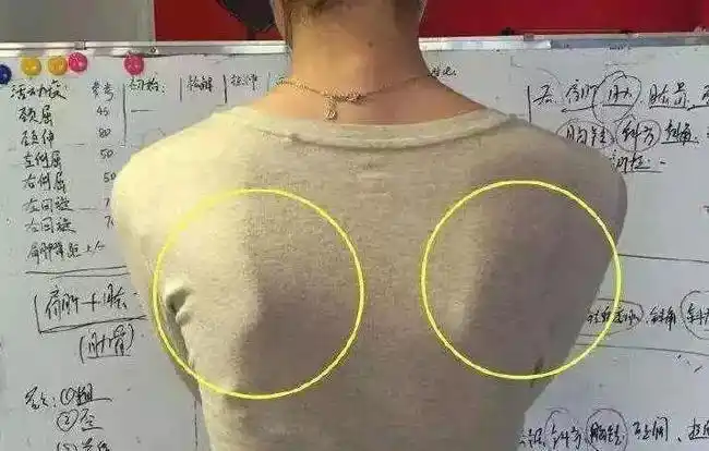 继发性的翼状肩胛一般是由肌力不平衡导致,影响肩胛骨活动的主要有四