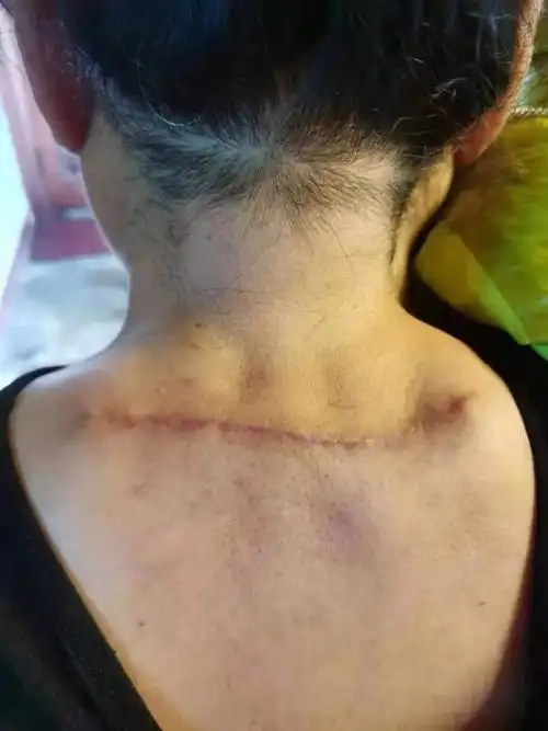 骨科常规开展富贵包切除术