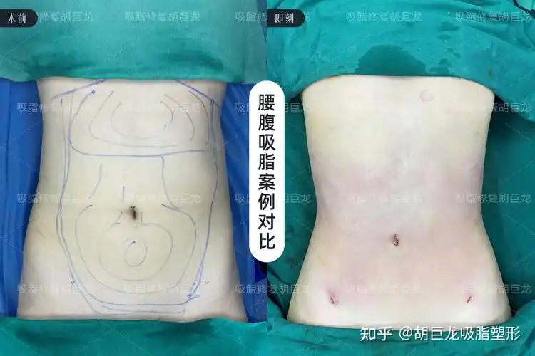 宝丽太腰腹吸脂术后即刻反馈